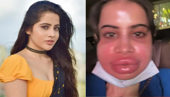 ঠোঁট ফুলে বেহাল দশা উরফি জাভেদের