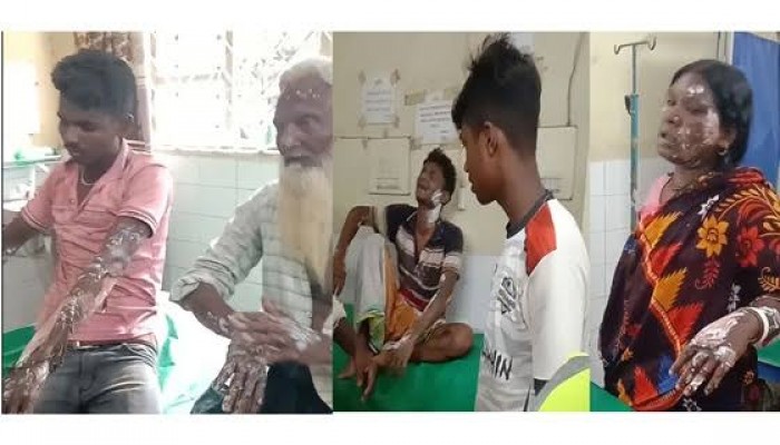 রাজশাহীর গোদাগাড়ীতে গ্যাসের বেলুন বিস্ফোরণে সাতজন দগ্ধ