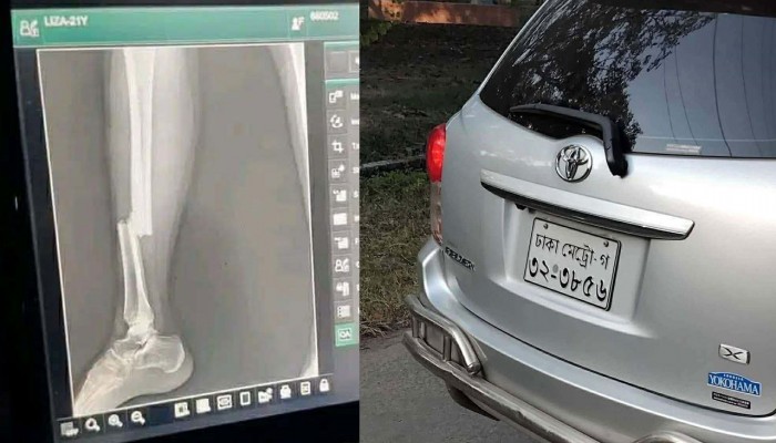 রাবিতে শিক্ষকের গাড়ির ধাক্কায় পা ভাঙলো ছাত্রীর