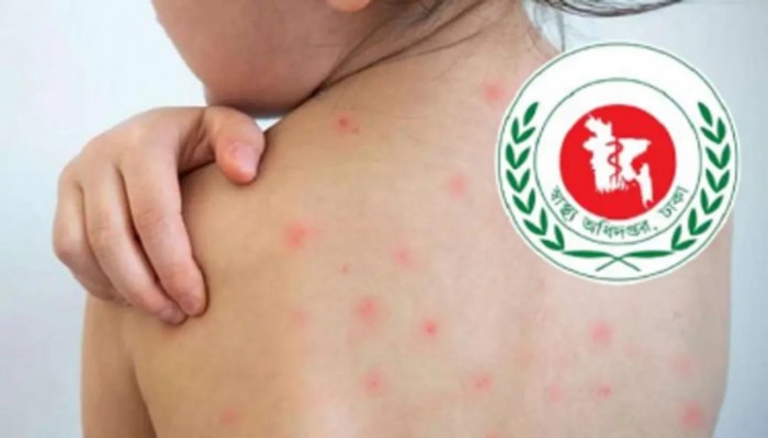 ২৪ ঘণ্টায় হাম ও উপসর্গে আরও ৮ শিশুর মৃত্যু